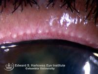 Stenosed gland orifices in a case of meibomian gland dysfunction.